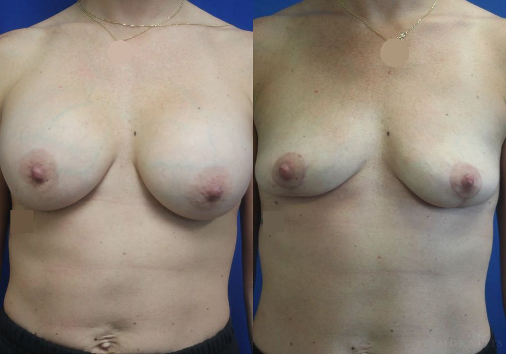 Breast Implant Removal with Lift - Thumbnail 2