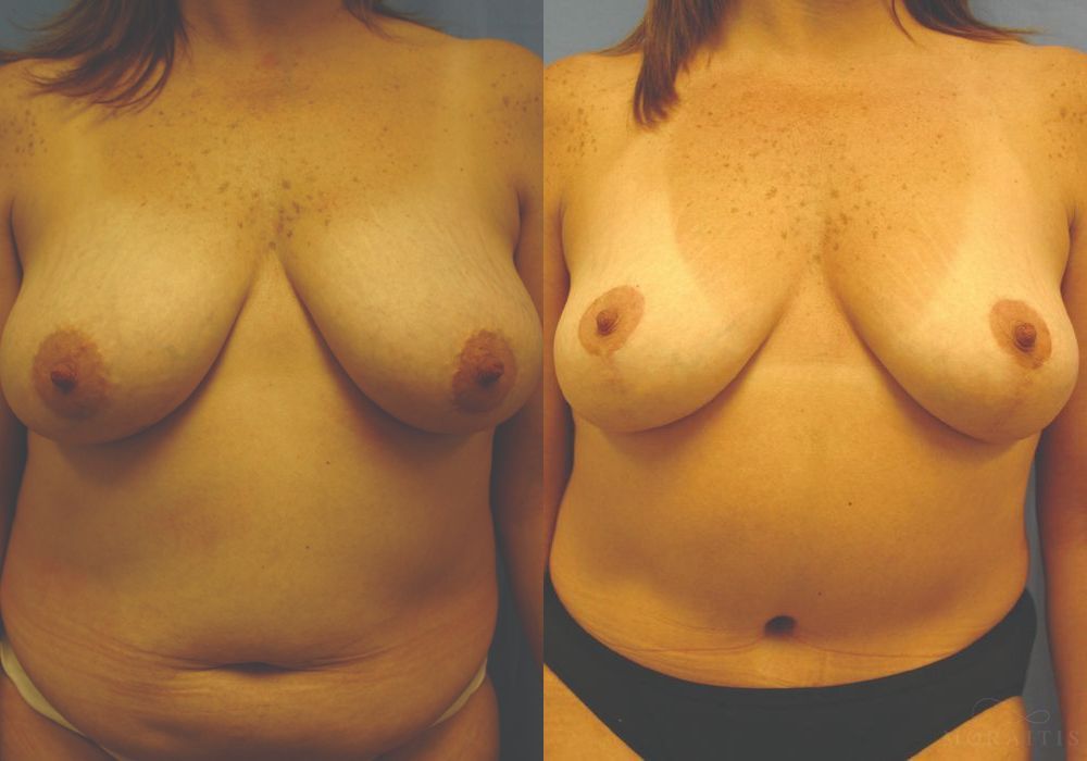 Breast Lift - Case 15440