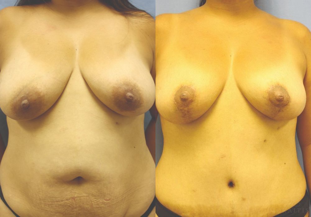 Breast Lift - Case 15441