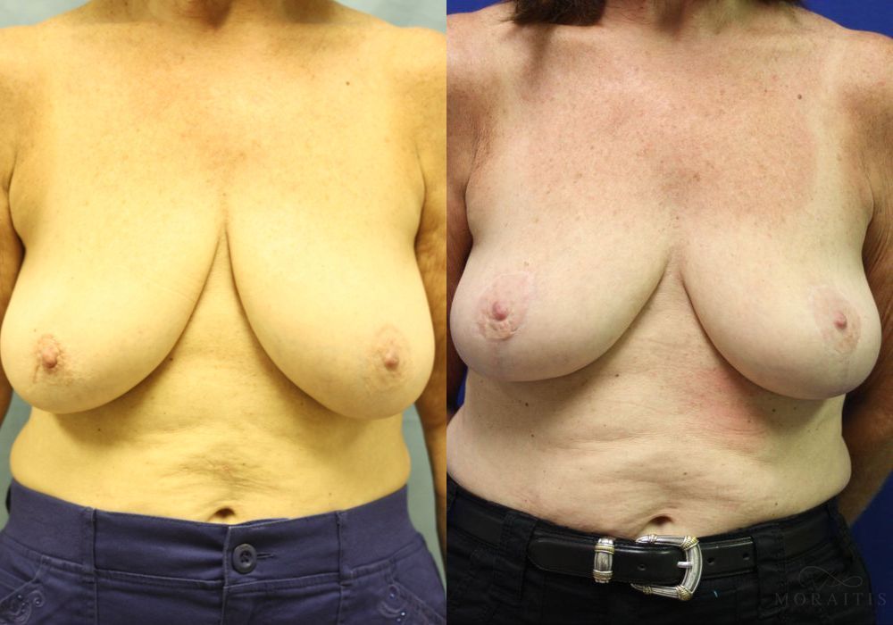 Before and after procedure result