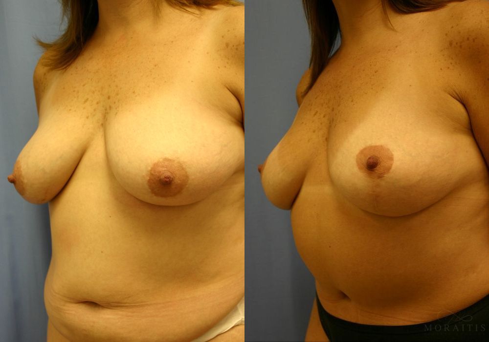 Breast Reduction - Thumbnail 2