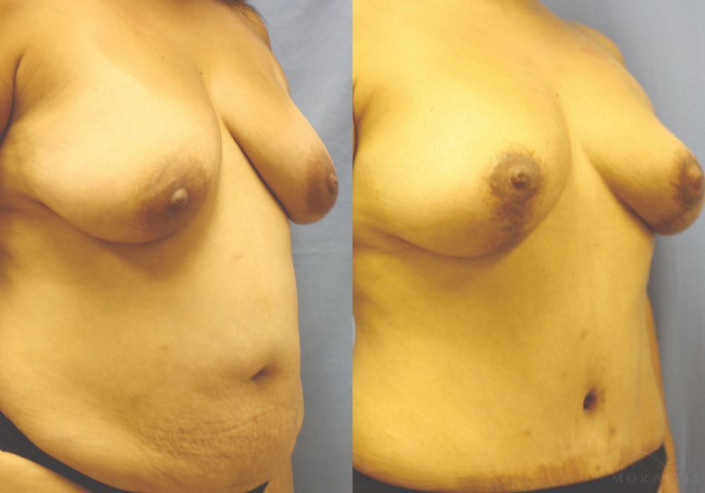 Breast Lift - Thumbnail 2