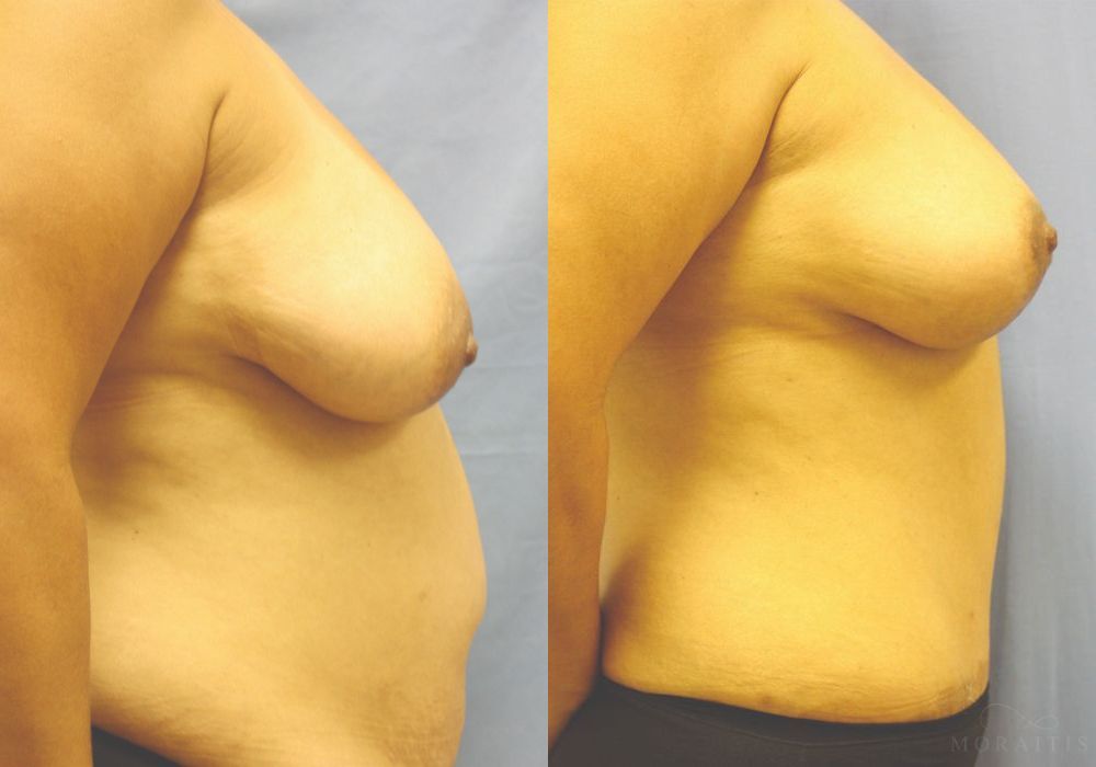 Breast Lift - Thumbnail 3