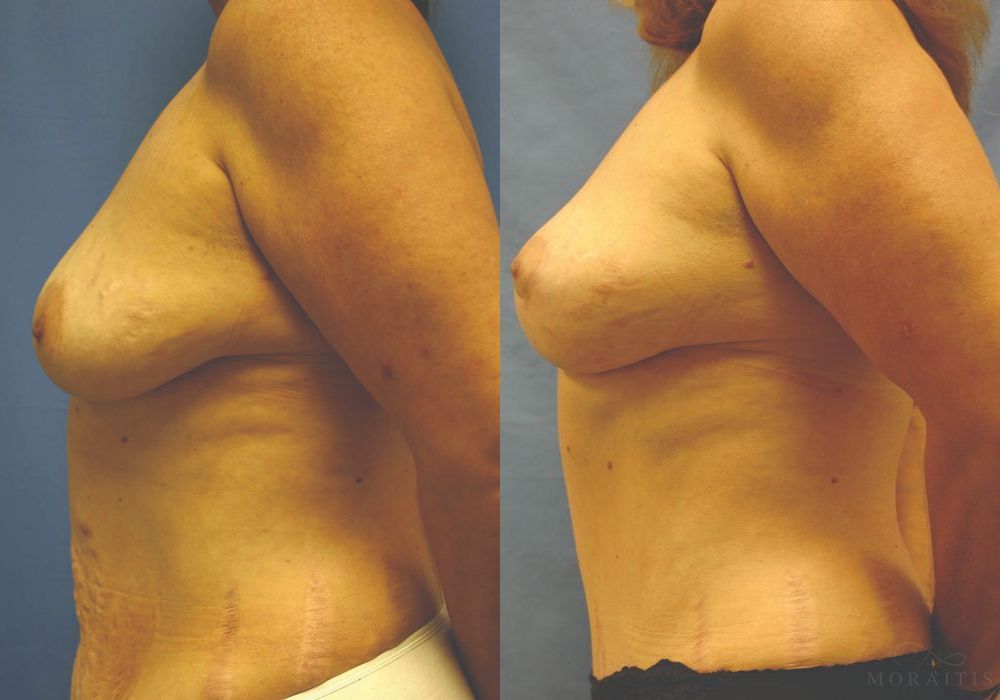 Breast Lift - Thumbnail 3