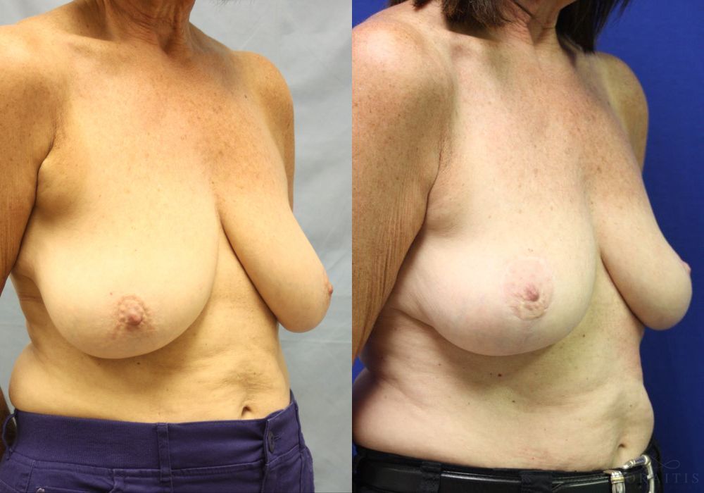 Breast Lift - Thumbnail 2