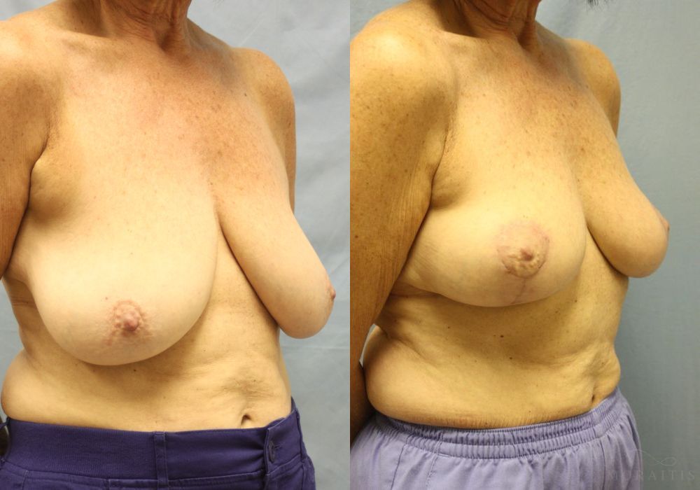 Breast Lift - Thumbnail 2