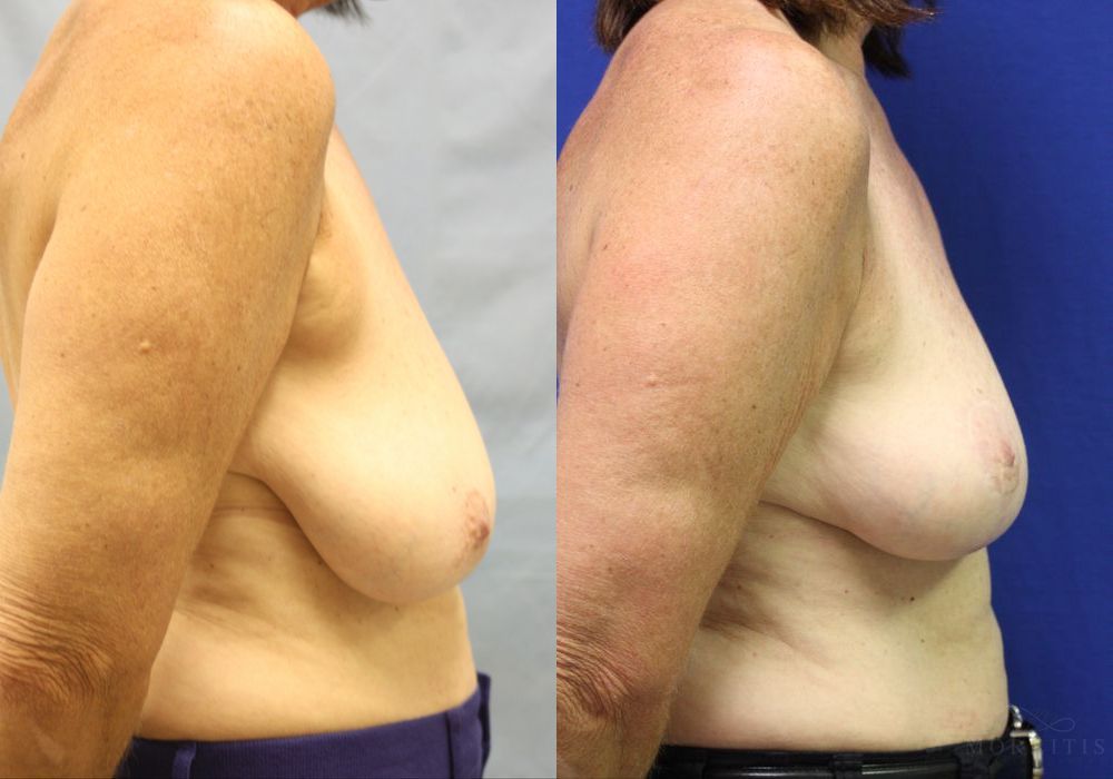 Breast Reduction - Thumbnail 3