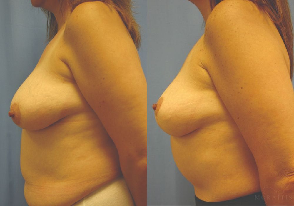 Breast Reduction - Thumbnail 3