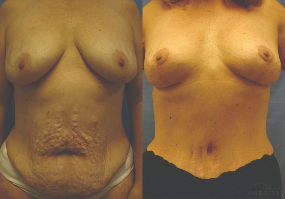 Breast Lift - Case 15439