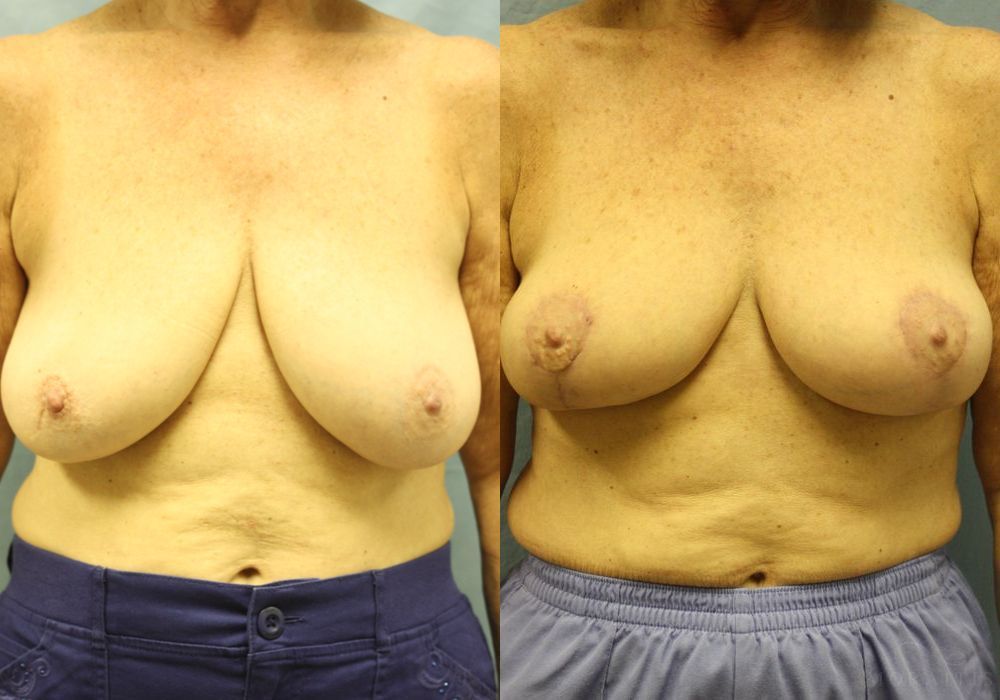 Breast Lift - Case 15444