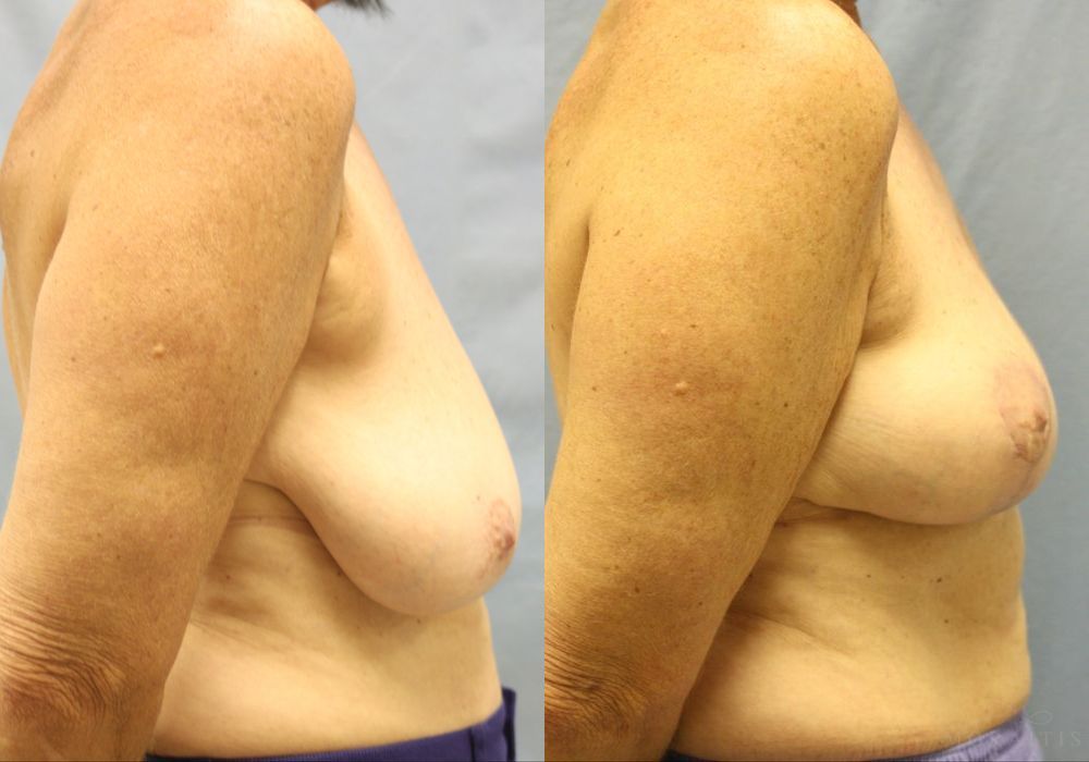 Breast Lift - Thumbnail 3