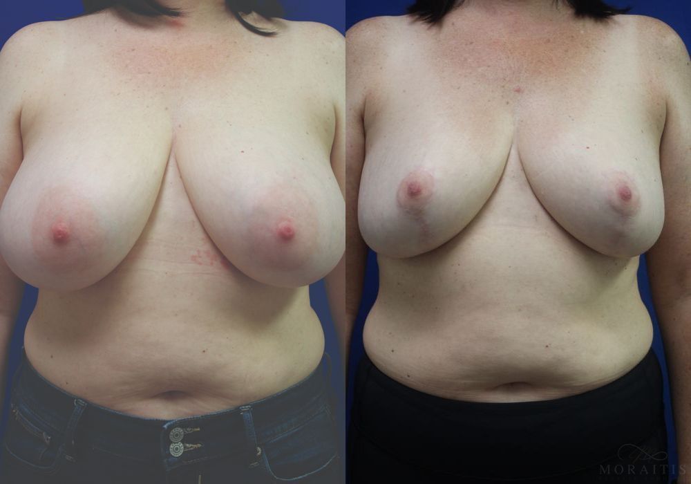 Before and after procedure result