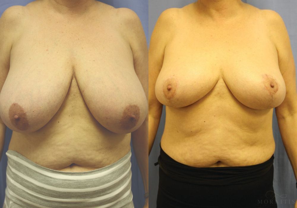 Breast Reduction - Case 15448
