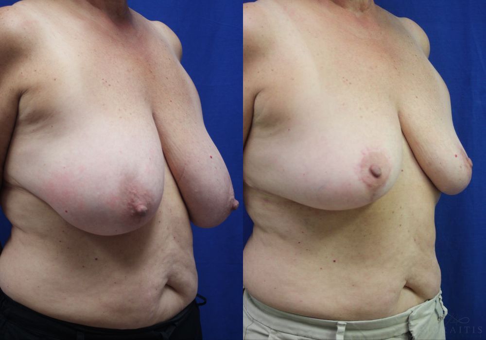 Breast Reduction - Thumbnail 2
