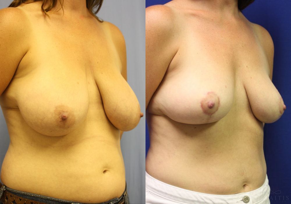 Breast Reduction - Thumbnail 2