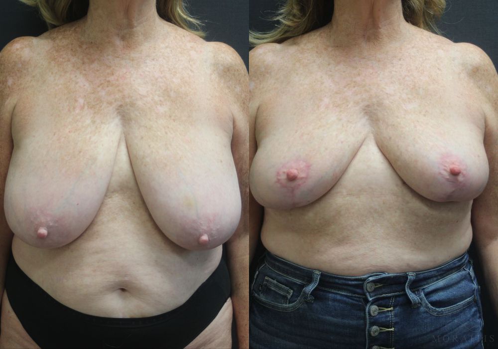 Breast Reduction - Case 15451