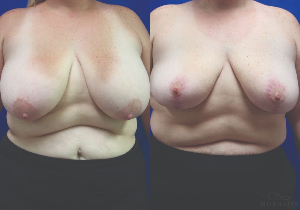 Breast Reduction - Case 15446