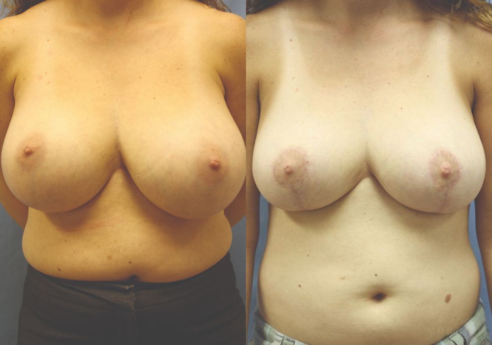 Breast Reduction - Case 15815