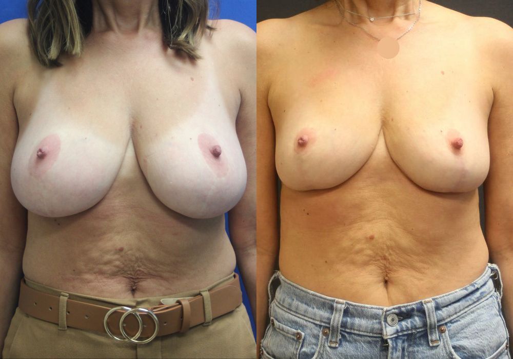 Breast Reduction - Case 15454