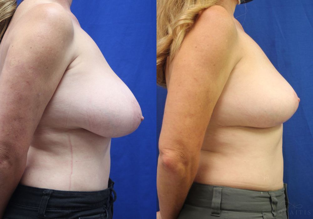 Breast Reduction - Thumbnail 3