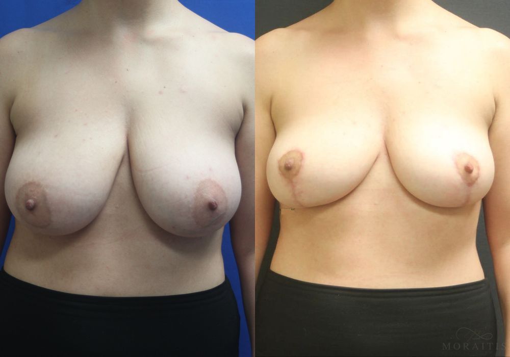 Breast Reduction - Case 15453
