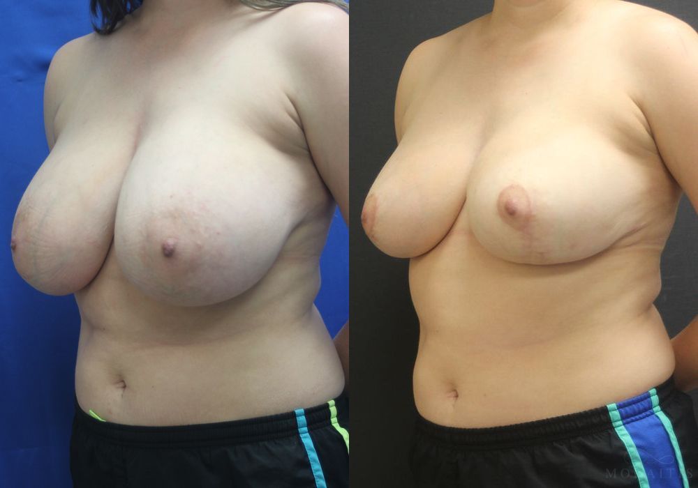 Breast Reduction - Thumbnail 2