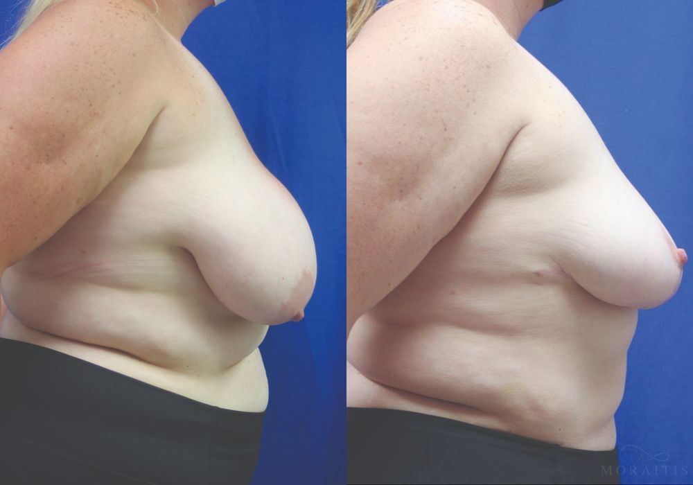 Breast Reduction - Thumbnail 3