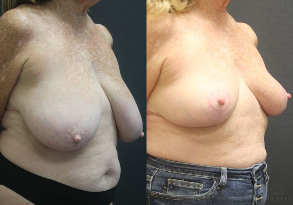 Breast Reduction - Thumbnail 2