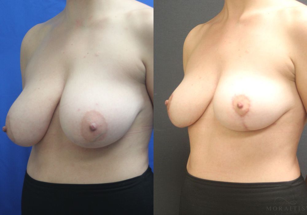 Breast Reduction - Thumbnail 2