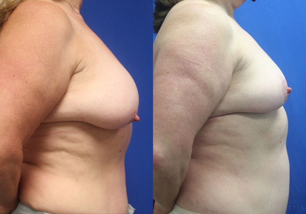 Breast Reduction - Thumbnail 3