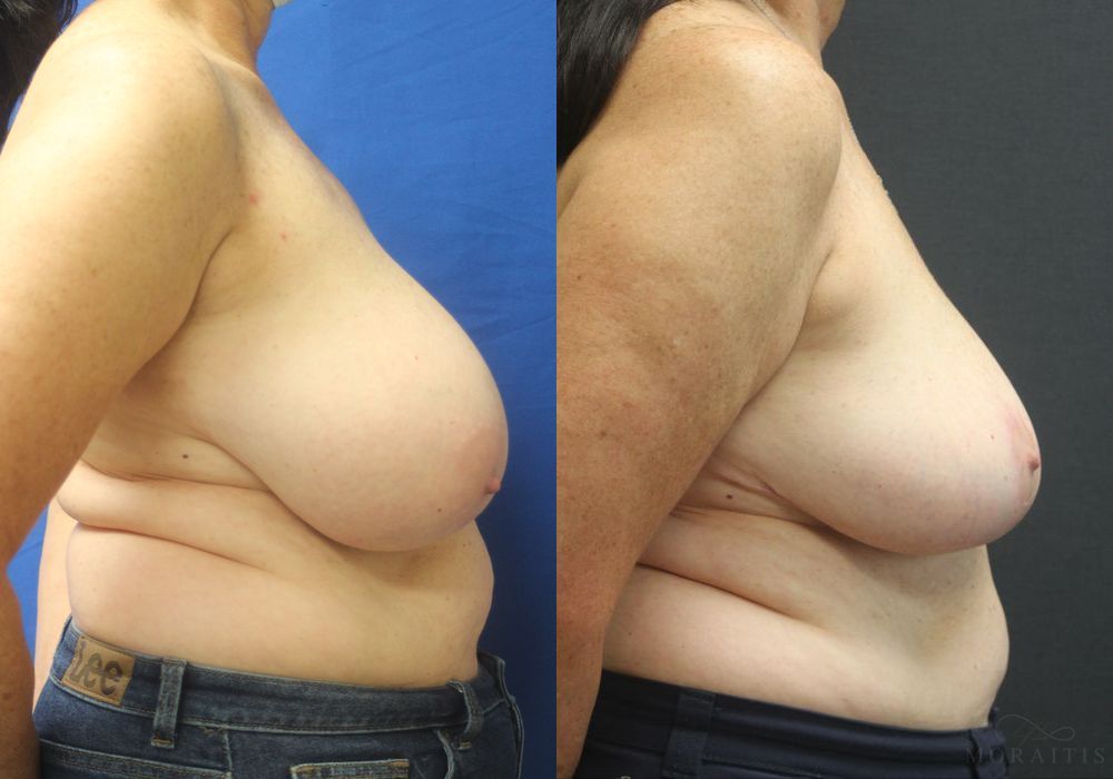 Breast Reduction - Thumbnail 3