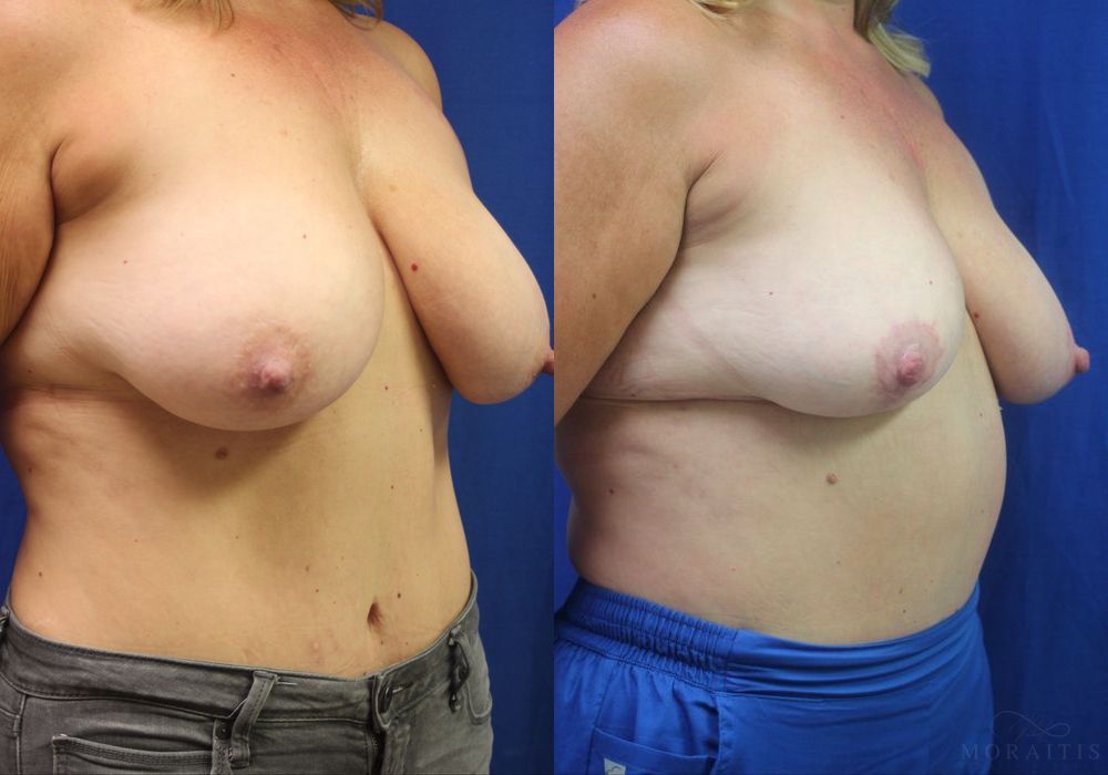 Breast Reduction - Thumbnail 2