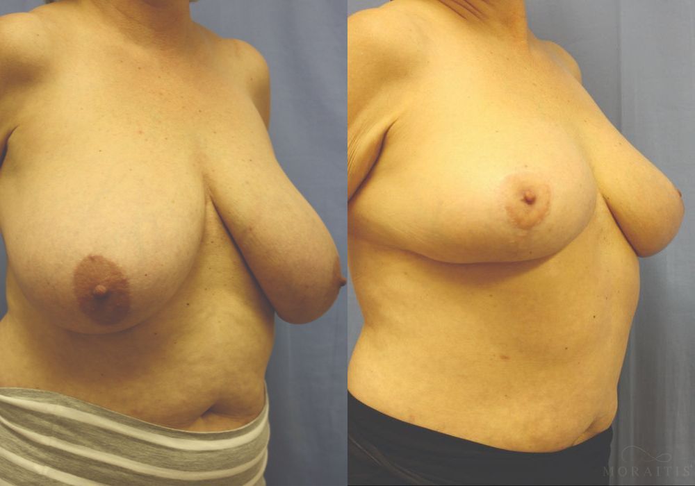 Breast Reduction - Thumbnail 2