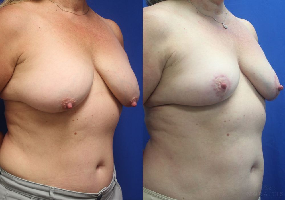 Breast Reduction - Thumbnail 2