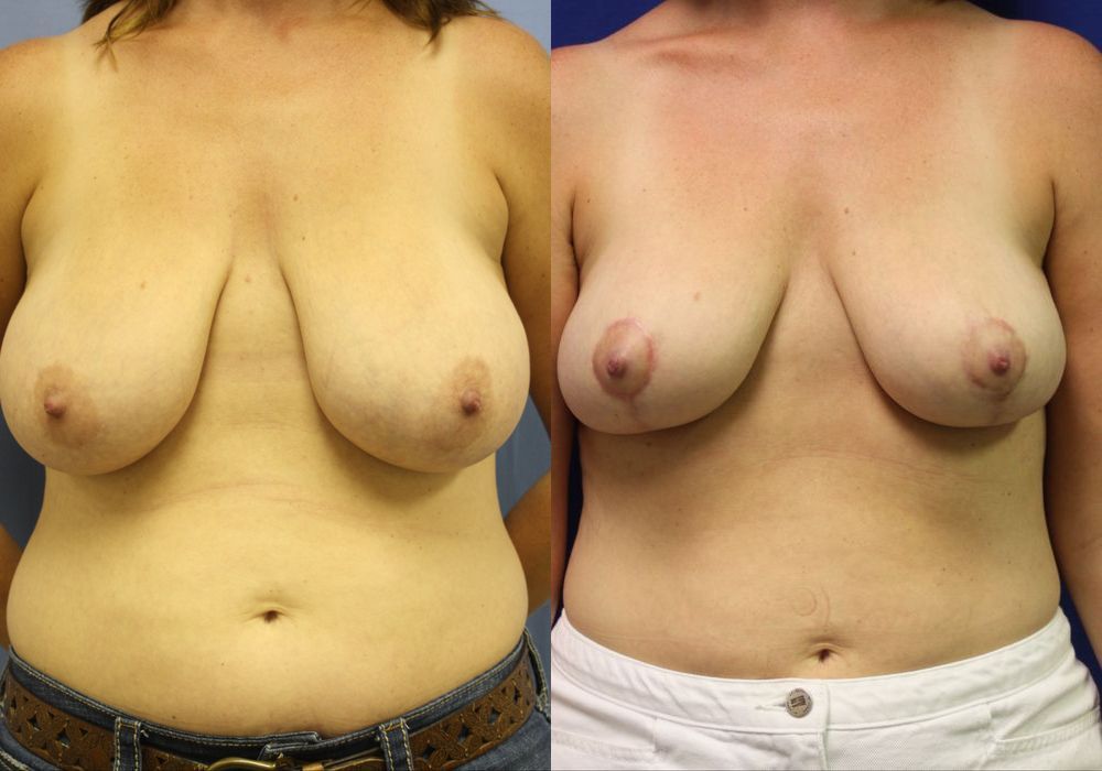 Breast Reduction - Case 15459