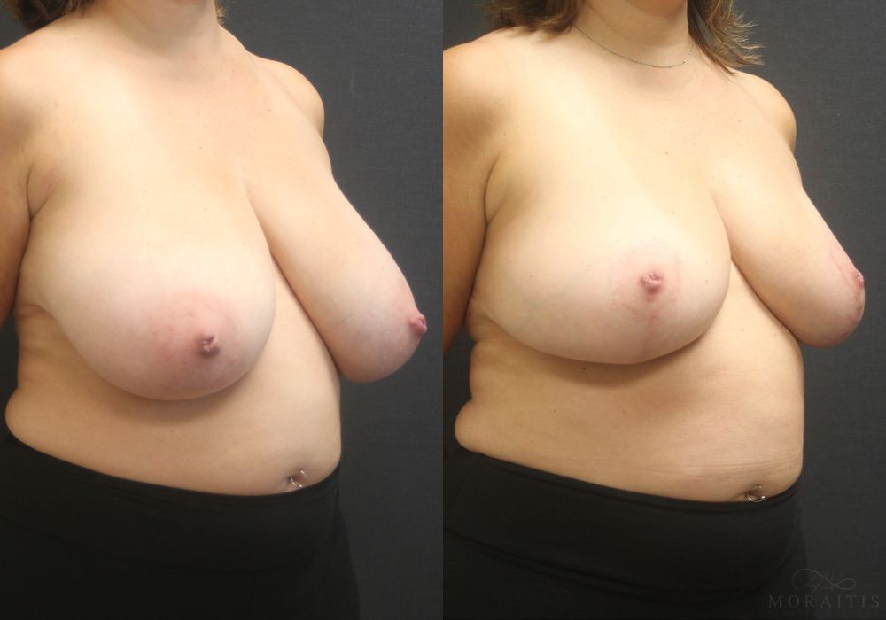 Breast Reduction - Thumbnail 2