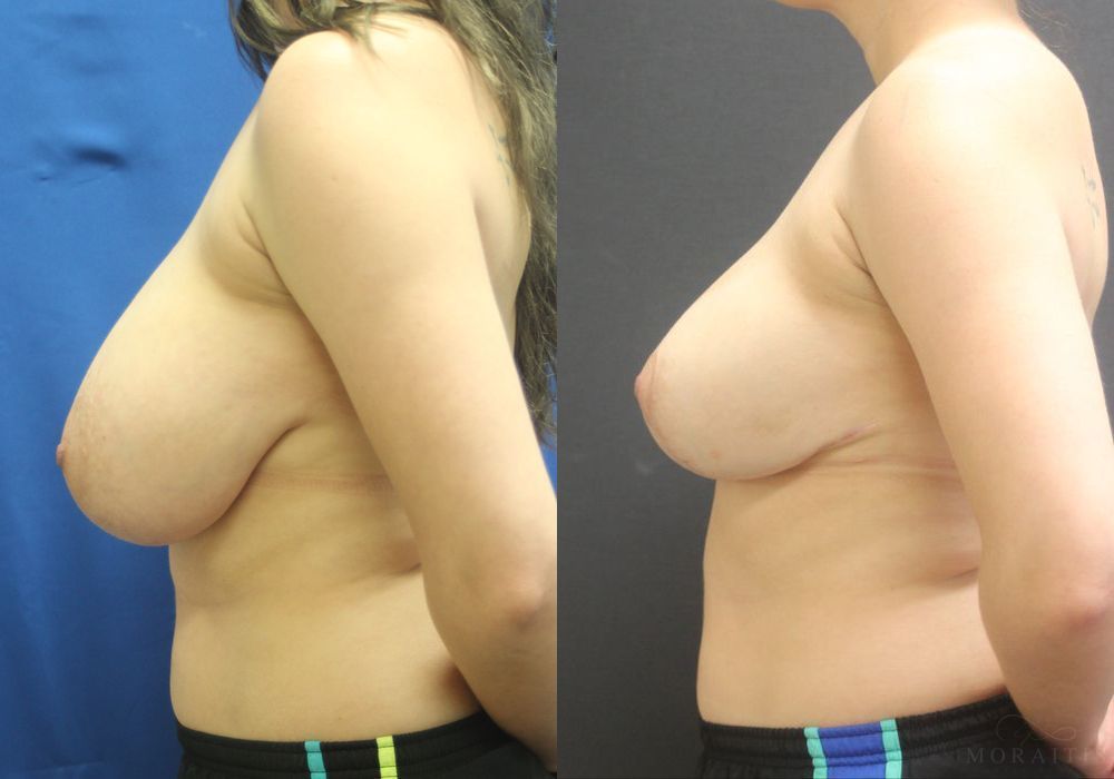 Breast Reduction - Thumbnail 3