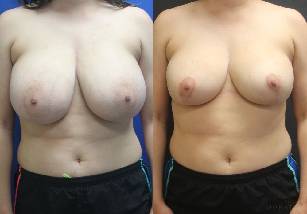 Breast Reduction - Case 15456