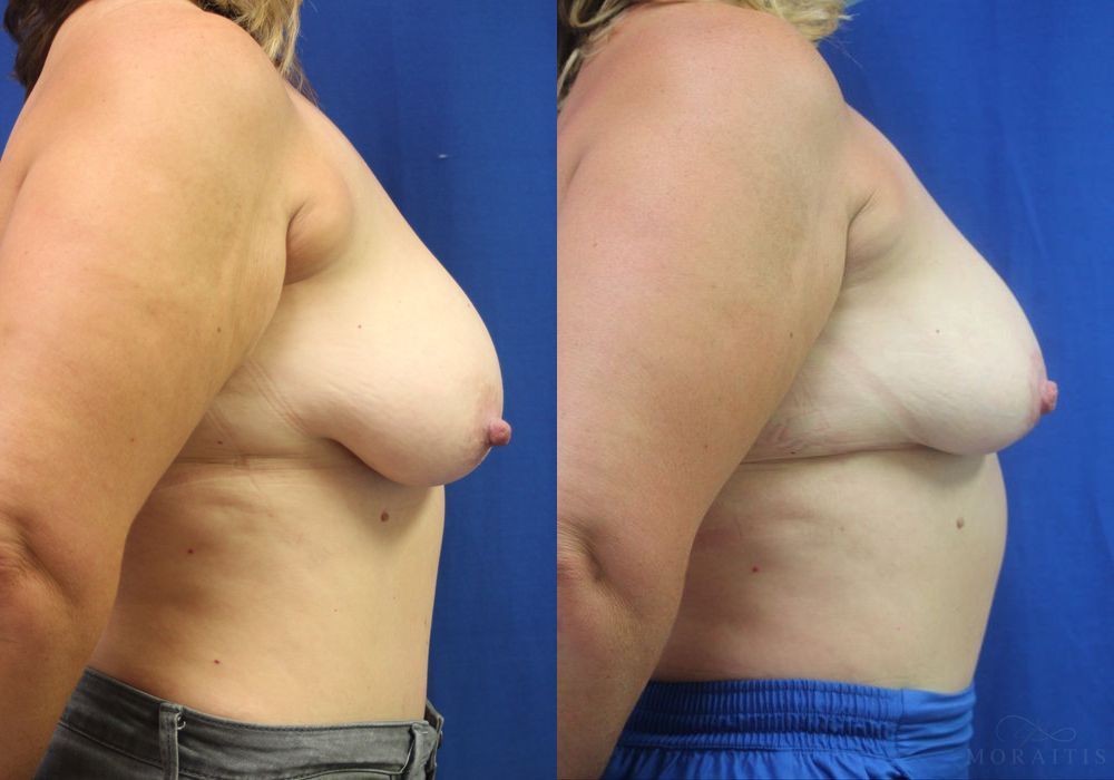 Breast Reduction - Thumbnail 3