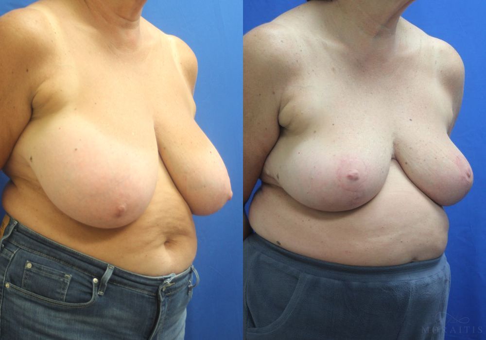 Breast Reduction - Thumbnail 2