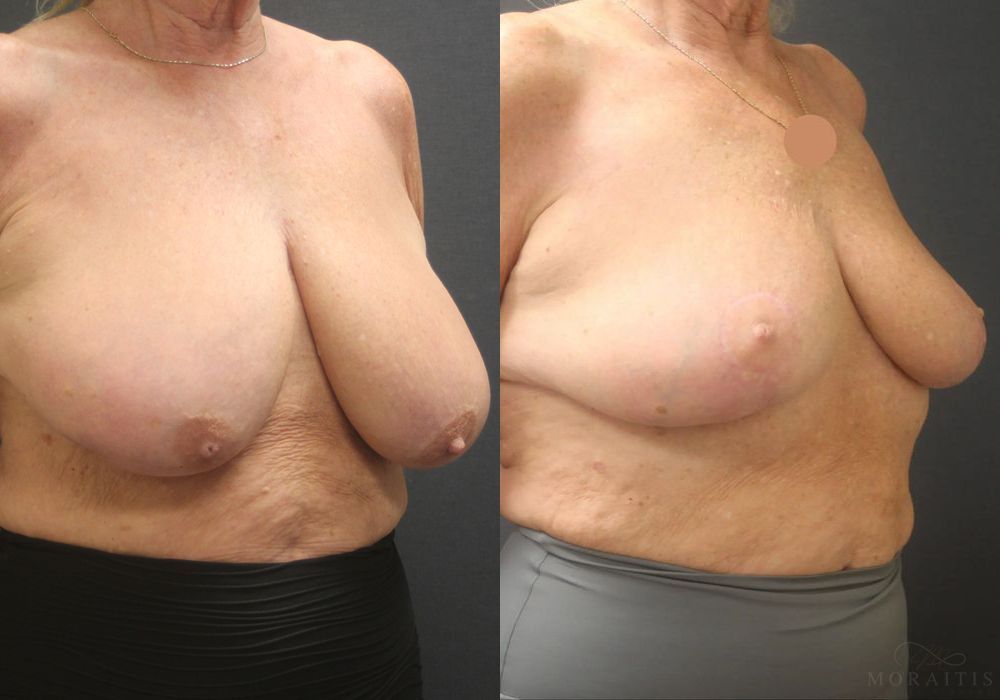 Breast Reduction - Thumbnail 2
