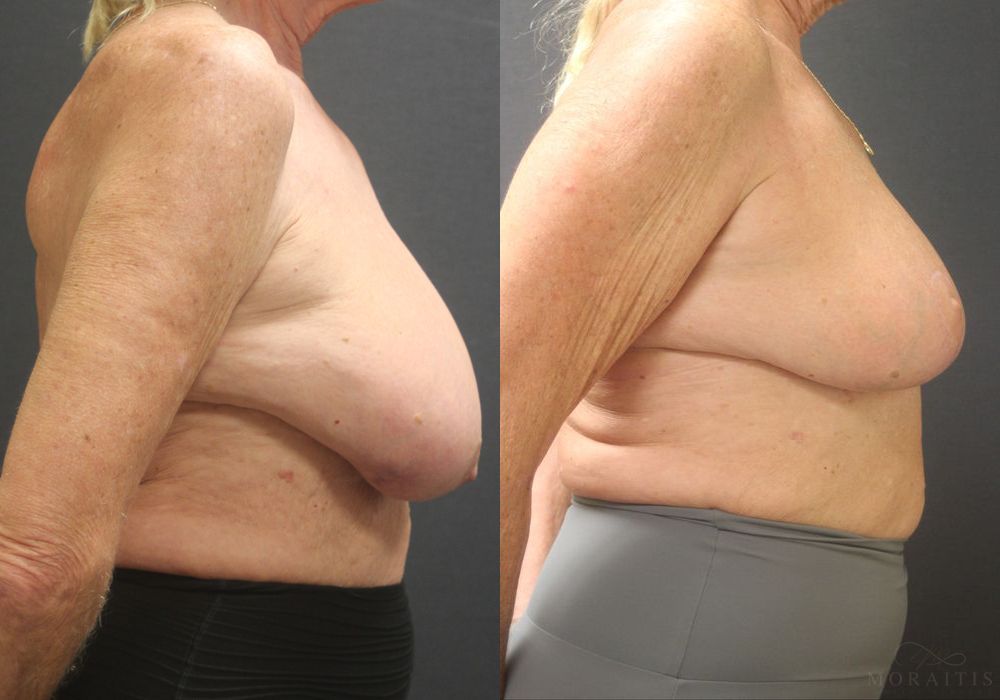 Breast Reduction - Thumbnail 3