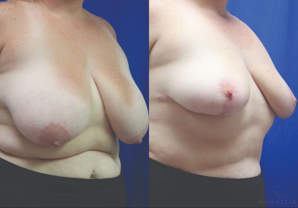 Breast Reduction - Thumbnail 2