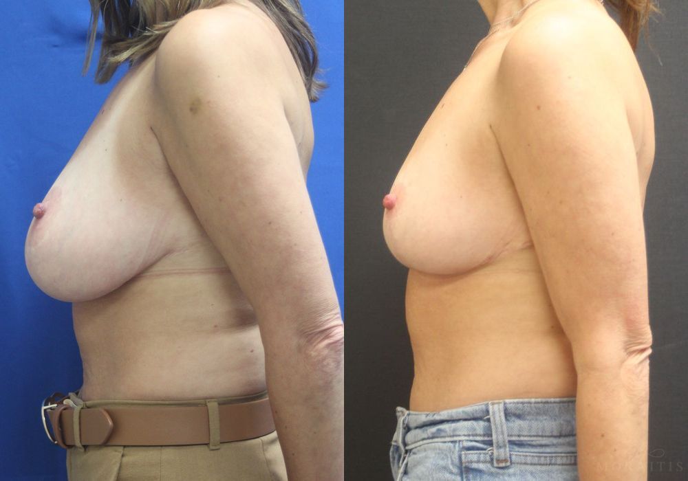 Breast Reduction - Thumbnail 3
