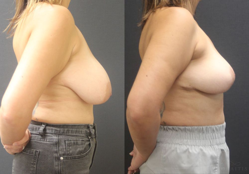 Breast Reduction - Thumbnail 3