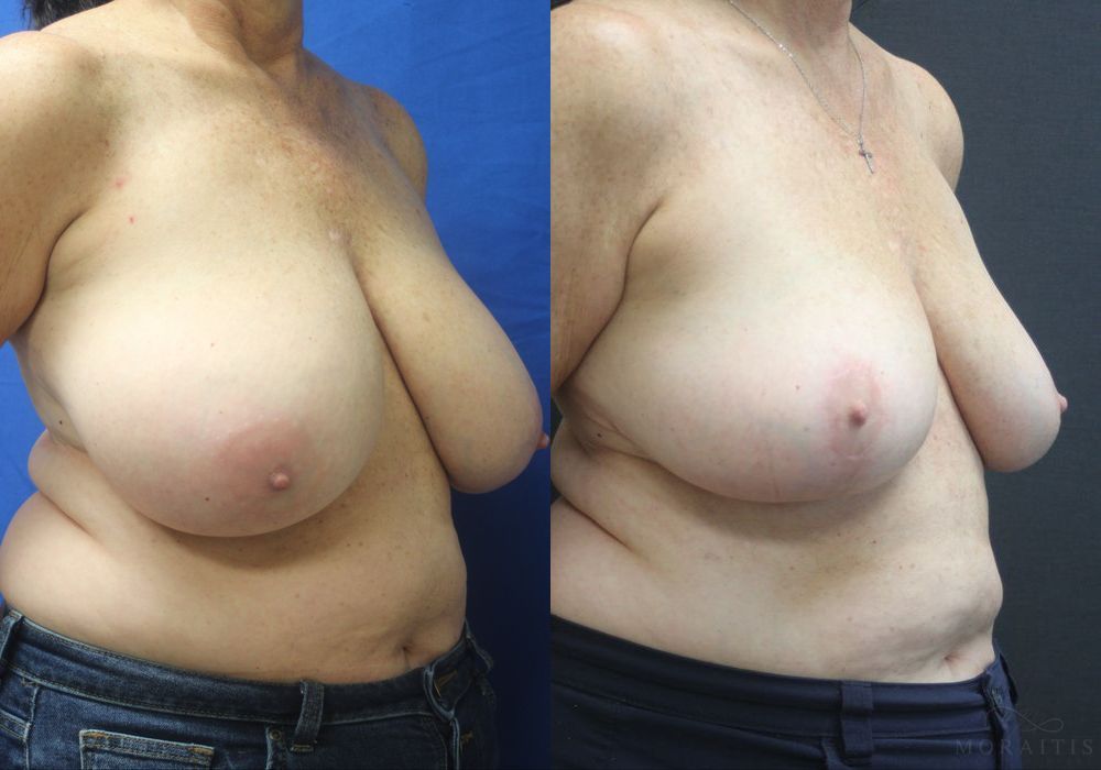 Breast Reduction - Thumbnail 2
