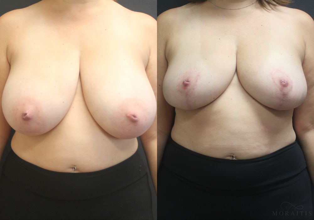 Breast Reduction - Case 15450
