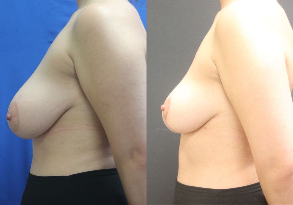 Breast Reduction - Thumbnail 3