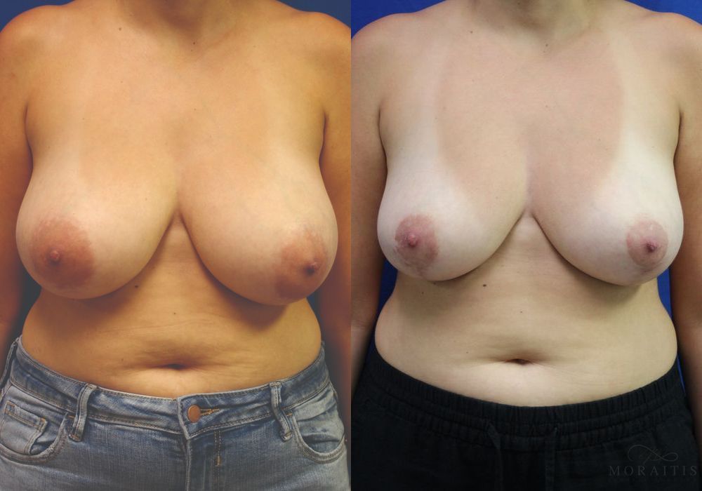 Breast Reduction - Case 15814