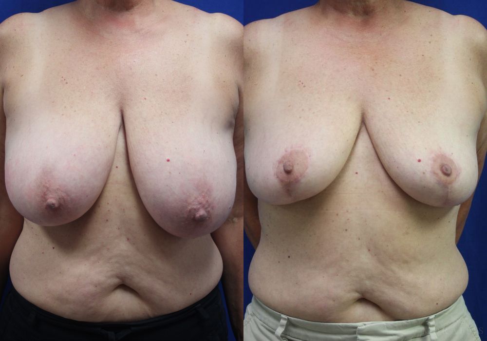 Breast Reduction - Case 15458